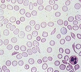 sickle_cell_anaemia.jpg