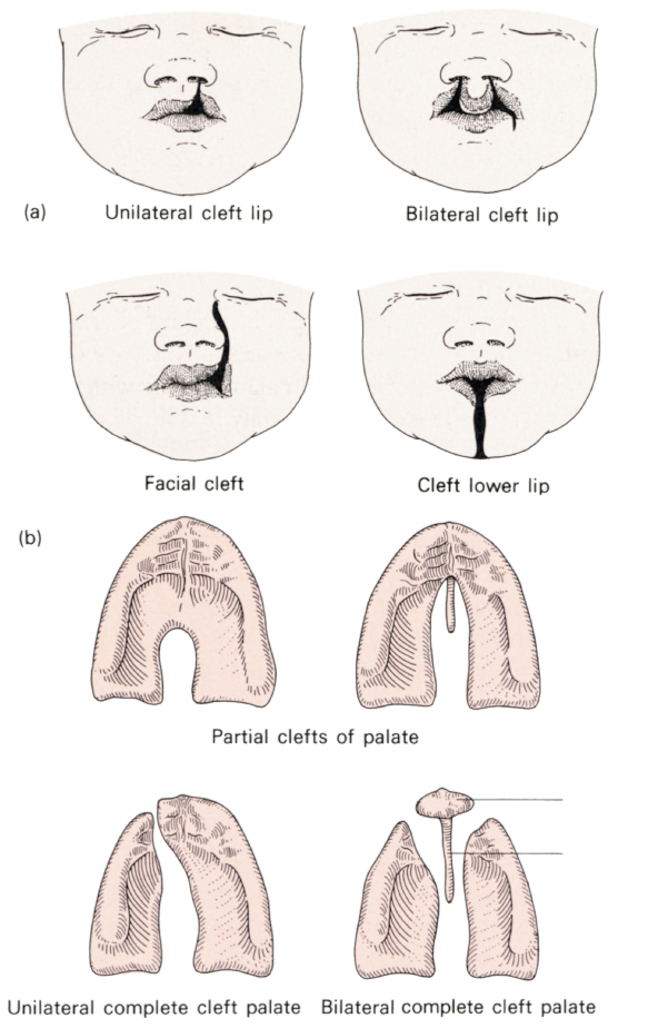 Cleft Palate Clinical Anatomy
